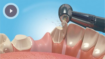 Dental Bridges